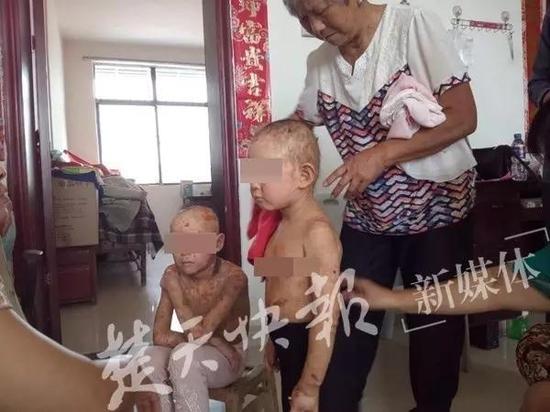 襄阳小姐妹怪病缠身