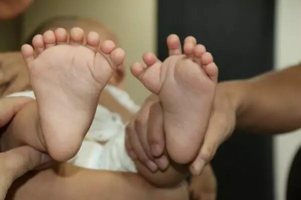 世界罕见!男婴长31个手指脚趾 已完成脚趾矫正 世界罕见!男婴长31个手指脚趾 已完成脚趾矫正