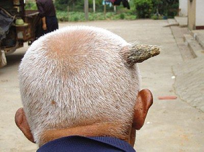 八旬翁头上长“角”